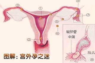 宫外孕图片