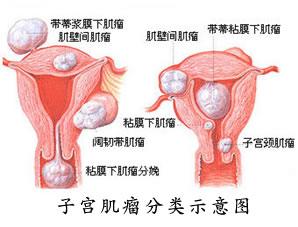 子宫肌瘤图片