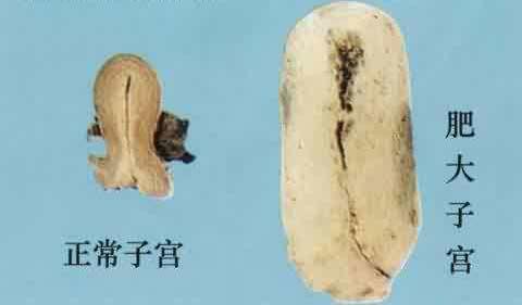 宫颈肥大图片