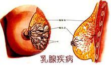 乳腺炎图片