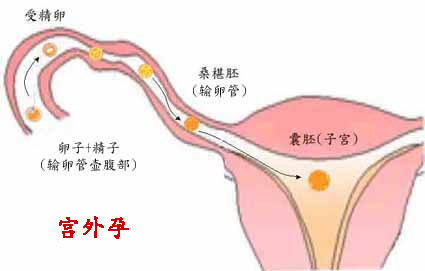 宫外孕图片