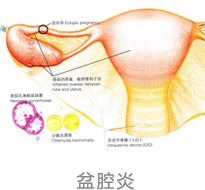 盆腔炎图片