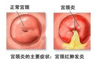 宫颈炎图片