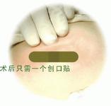 宫外孕图片