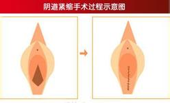 阴道紧缩术图片