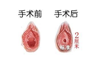 处女膜修复术图片