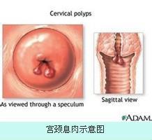 宫颈癌图片