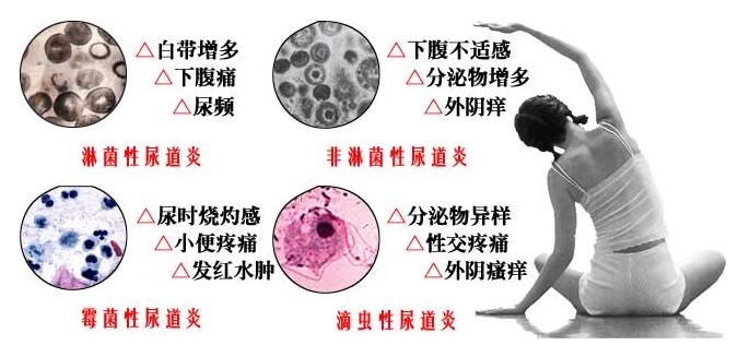 榆林博爱详解:女性尿道炎